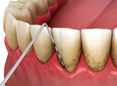 diagram of teeth and gums with gum disease