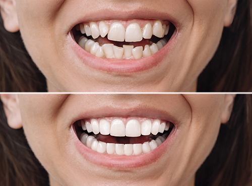 How does a smile makeover work in Santa Clarita