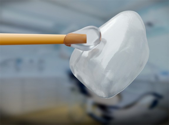 Close-up of dental veneer