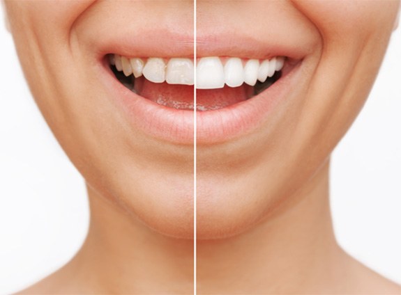 Close-up woman’s smile before and after veneers